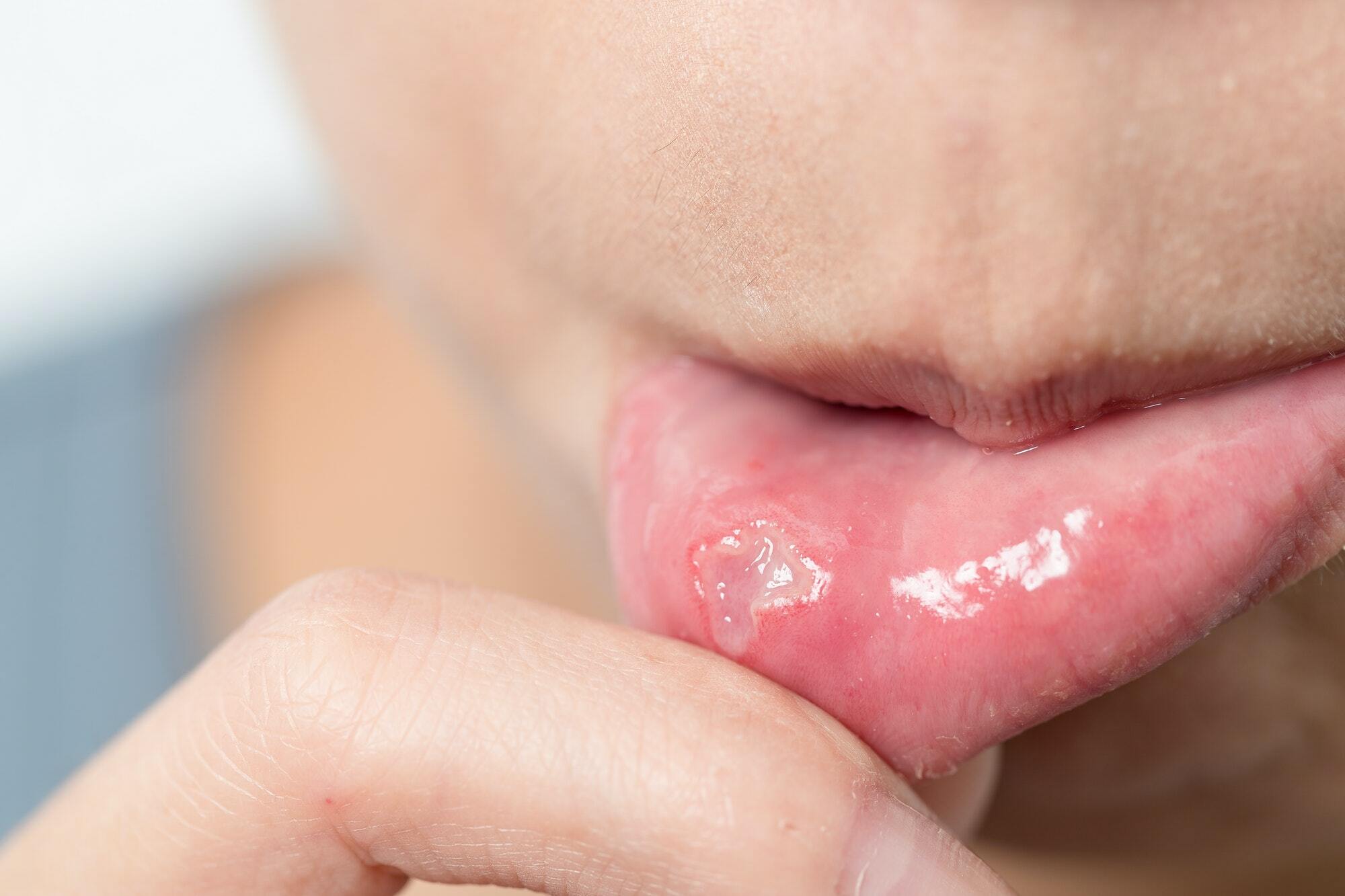 Woman suffer from aphthous stomatitis